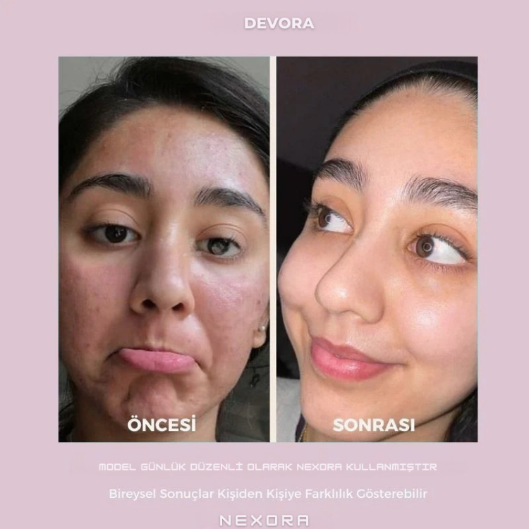 Nexora | LED Işıklı Titreşimli Yüz ve Boyun Sıkılaştırma Terapi Cihazı